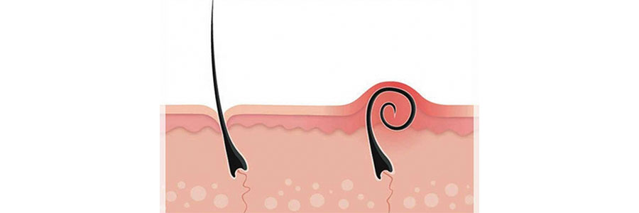 Laser Hair Bleaching Permanent
