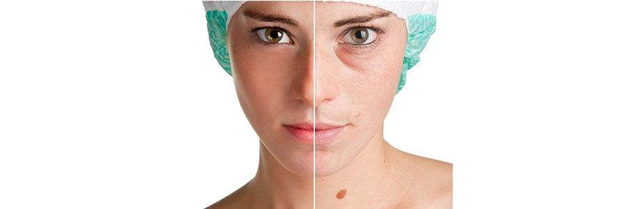 Mole Removal Laser Treatment
