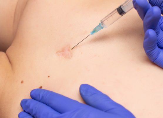 Mesotherapy for Sports Injuries