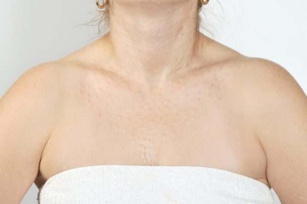 Neck and Decollete Mesotherapy